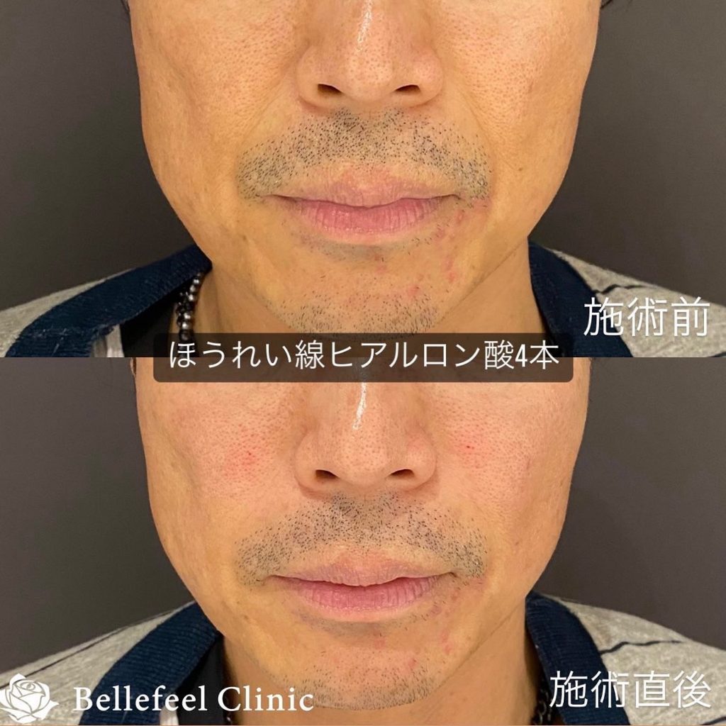 ヒアルロン ほうれい線】ヒアルロン酸注入（ジュビダームビスタ ボリューマ